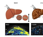 병들어 ‘딱딱해진 장기’ 알아낼 신기술 개발