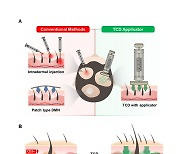 연세대, 새 '원형탈모 치료제' 개발…마이크로니들 기술 기반