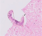 해외여행 다녀온 뒤 발열·복통에 간기능 이상 있다면…‘개회충’ 감염 여부 꼭 확인해보세요