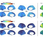 "조기 발병` 알츠하이머 진단 가능성 열렸다"