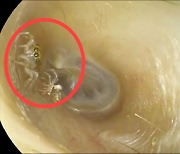 "귓속에서 나는 '바스락' 소리"…병원서 발견된 '이것'에 경악