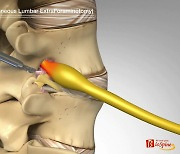 '수동 물펌프와 닮은 꼴' 척추 … 막힌 곳은 추간공확장술로 치료