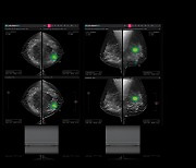 루닛, 3D 유방암 검진 ‘루닛 인사이트 DBT’ 美 FDA 승인 획득