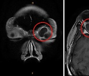 눈 주변에 생기는 종양, ‘안와 양성 종양’ 종류와 치료법은?