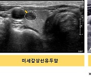 수술 안 한 미세 갑상선암, ‘두 가지’ 있으면 진행 위험 높다