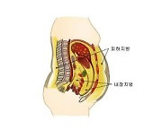 "내장지방 많으면 이거 조심해야"…치매 위험 높아