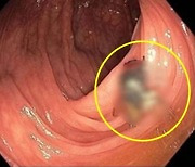 "대장 내시경 하는데 살아있는 파리가"…男에 무슨 일이