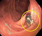 "대장에 붙은 '살아있는' 파리, 실화?"···내시경 하던 의사들 '깜짝'