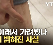 [자막뉴스] '원인 불명' 가려움증...수수께끼 퍼즐 풀렸다