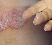겨울철 심해지는 피부질환 '건선'…효과적 치료물질 개발