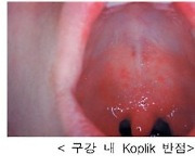 면역력 떨어진 사람 90% 이상 감염…코로나 지나자 급증한 병