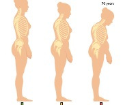 혹시 골다공증 고위험군?...간단 검진법은
