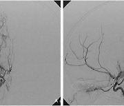 '아지랑이처럼 뇌혈관 피어오르는' 모야모야병 방치하다간…