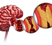 고지혈증 없는데…계속 복용 괜찮을까요[뇌졸중 극복하기]