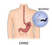 "위장 헬리코박터균 감염, 치매 위험과 연관"