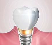 임플란트, 건강하게 오래 사용하려면 '이렇게' [건강톡톡]