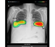 루닛, 삼성전자 엑스레이 장비에 흉부·응급질환 AI 솔루션 공급