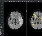 제이엘케이, 뇌졸중 분석 '원천 기술' 유럽 특허 획득