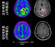 '최적의 뇌종양 수술 위치' 반응성 별세포 영상으로 찾는다