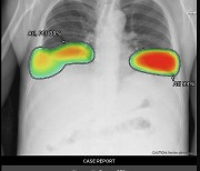 ‘루닛 인사이트 CXR’, 폐결절 검출 능력 글로벌 제품 중 최우수