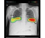 루닛, 'AI 폐결절 검출 능력' 세계 7개제품 중 '최우수'