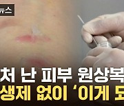 [자막뉴스] 항생제 안 썼는데도...놀라운 '상처 치료' 기술 탄생