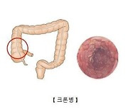 덴마크 연구팀 “IBD, 진단 전 처방약 증가와 관련”