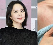 '이혼' 박지윤, 쇄골에 할퀸 듯한 붉은 흉터…"출산 직후 생겨"