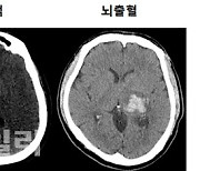 뇌 CT·MRI 무슨 차이일까[뇌졸중 극복하기]