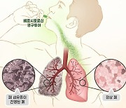 대웅제약 특발성 폐섬유증 신약 ‘베르시포로신’, 유럽서 희귀의약품 지정돼