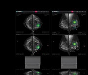 AI startup Lunit's 3D breast cancer screening tech hits U.S.