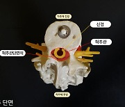 척추전방전위증 새 수술 기준 제시