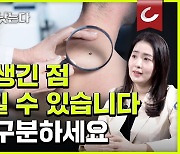 갑자기 생긴 점 혹시 피부암? ‘ABCDE’로 자가진단해 보세요