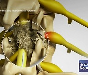 추간공의 인대와 신경에 생긴 유착으로 인한 통증... 추간공확장술로 치료