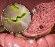 내시경으로 위 선종 절제해도… ‘헬리코박터균’ 없애야 위암 감소
