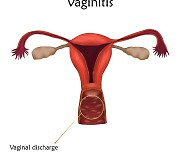 폐경 후 질염, 90% 이상은 ‘이것’