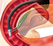 성원메디칼, ERCP Guide Wire ‘TRU WIRE’ 수출 확대… 500만달러 규모 성장 목표