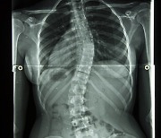 우리 아이 키가 줄었다?…‘척추측만증’ 대처법은