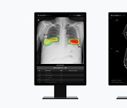 루닛, 대만·싱가포르 의료기관에 AI 솔루션 공급