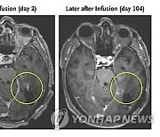 Brain Tumors