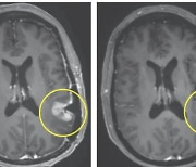뇌종양 '교모세포종' 환자 5일 만에 기적 만든 치료는?
