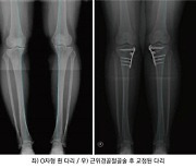 [굿클리닉]관절염 원인 O자형 휜다리...'교정술+줄기세포술'로 연골재생효과 입증