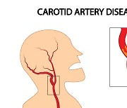 아무 증상 없어 더 위험한 이 질환[뇌졸중 극복하기]
