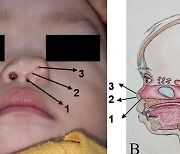 왼쪽 콧구멍 3개로 태어난 인도네시아 男 아기… 수술은 가능할까?