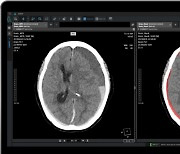 코어라인소프트 "뇌출혈 의료 AI, 16개 병원서 비급여 청구 시작"