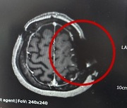 톱날 머리뼈 박힌 채 봉합…뇌수술 환자 '황당'
