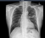 뷰노, UAE 군병원에 흉부 엑스레이 AI 솔루션 도입…"하반기 FDA 허가 목표"