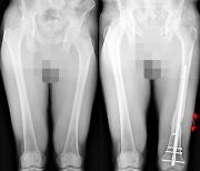 ‘하지부동‘ 다리길이가 다른 사람의 치료법 [정형외과의 미용적수술, 사지연장술, 휜다리수술]