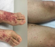 발·다리 순식간에 뒤덮은 '빨간 반점'… 흔히 쓰이는 '이 약' 부작용이었다?