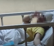 13살 필리핀 소녀​ 개에 물려 사망… 사인은 ‘이 병’